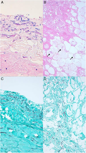 Tinciones de hematoxilina-eosina A), PAS B) y Grocott C y D) que ponen de manifiesto la presencia hifas de hongos filamentosos en el tejido conectivo-adiposo, sin evidencia de componente inflamatorio acompañante.