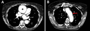 (A) Aneurysm of the ascending aorta, measuring 55mm×64mm, and located immediately above the aortic suture (asterisk). (B) Perivascular inflammatory signs in the arch of the aorta (red arrow).