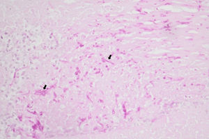 Periodic acid-Schiff (PAS) stain showing necrosis, a polymorphonuclear neutrophilic infiltrate and filamentous structures compatible with hyaline septate fungal hyphae (black arrows).
