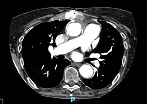 A computed tomography angiography performed 3 months after surgery, showing resolution of the aneurysm, and dismissing mechanical complications associated with the aortic prosthesis.