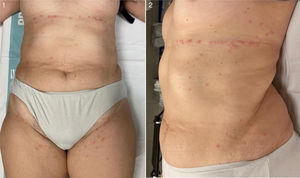 Pápulas eritematosas submamarias, axilares e inguinales.