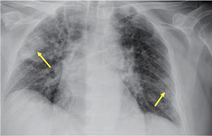Radiografía de tórax con desarrollo de infiltrados pulmonares bilaterales de predominio periférico (flechas).
