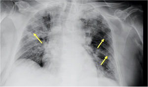 Radiografía de tórax con progresión de los infiltrados pulmonares bilaterales y aparición de cavitaciones sugestivas de infección fúngica (flechas).
