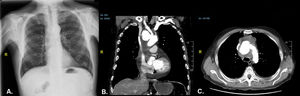 A) Radiografía de tórax donde se objetiva un leve ensanchamiento mediastínico. B) Tomografía de tórax, corte coronal y axial (C), donde se objetiva un aneurisma micótico dependiente del arco aórtico y moderado derrame pericárdico asociado.