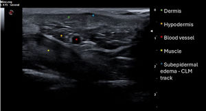Ultrasound image of the skin 15MHz linear probe: transverse position relative to the track left by larva migrans. The different skin layers – epidermis, dermis, subcutaneous tissue, and muscle – are clearly visible. In the central area, a hypoechoic zone is evident, displaying posterior acoustic enhancement, corresponding to the larva migrans’ migratory path, with associated subepidermal edema. As oral ivermectin treatment had been initiated 48h earlier, only the larval migratory track was captured.