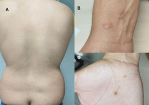 Resolution of lesions in the back (A) and the right wrist (B and C).
