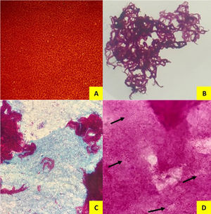 BAAR en diferentes tinciones y muestras. A) Tinción de auramina de líquido articular (x20). B) Tinción Ziehl Neelsen de cultivo de líquido articular, agrupación típica en cordones de Mycobacterium tuberculosis (x10). C) Tinción Ziehl Neelsen de cultivo de absceso (x100). D) Tinción gram de absceso con presencia de bacilos fantasma (x100).