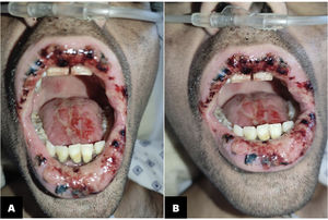 Stomatitis on both lips and the dorsum of the tongue.