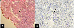 Skin biopsy. (A) Lip epithelium with hematoxylin and eosin stain showed the hallmark histologic feature of Cytomegalovirus infection with a large intranuclear inclusion densely eosinophilic (dotted arrow). (B) Immnohistochemical reaction confirming the presence of the virus (continuous arrow).