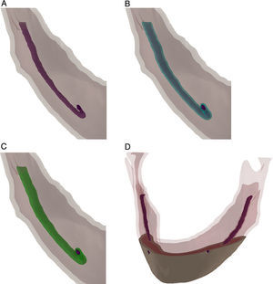 Passos para determinação do canal mandibular. (A) O canal segmentado da tomografia, (B) superfície de offset ao redor do canal, (C) operação de combinação para determinar as áreas comuns entre a mandibular e o ligamento e remoção da porção interna do canal, (D) resultado final.
