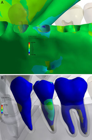 Resultados do teste de simulação. Tensão hidrostática no osso cortical (A) e tensão máxima principal em alguns elementos dentários (B).
