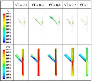 Evolución temporal de las tensiones tangenciales en la pared (imágenes superiores) y contornos de velocidades en el plano medio (imágenes inferiores) para la técnica «culotte» en bifurcación a 45°.