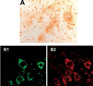 A: inmunohistoquímica convencional; se puede observar el patrón de inmunorreactividad característica de los IgG-NMO que marcan los microvasos de la sustancia blanca del hipocampo de rata. B: células HEK transfectadas con el gen de la acuaporina 4, clonado en el vector pEGFP-C1 (fluorescencia verde) (B1), y suero de un paciente con IgG-NMO positivo por inmunohistoquímica convencional (anticuerpo secundario fluorescente rojo) (B2).