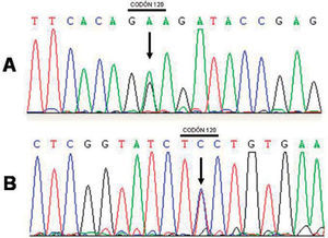 Secuencia de ADN del exón 5 de PSEN1 donde se muestra la mutación E120G (flecha). A: secuencia directa. B: secuencia inversa.