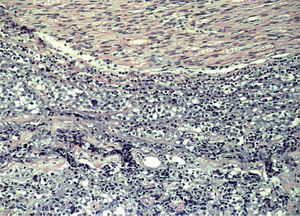 Proceso linfoproliferativo difuso constituido por células grandes, que infiltran nervio periférico (parte superior de la imagen). H-E, original ×400.