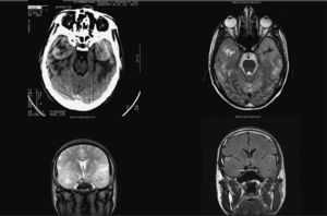 Metástasis bilaterales de meduloblastoma.
