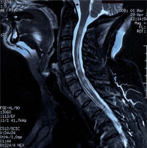 Resonancia magnética medular que muestra lesiones desmielinizantes cervicodorsales.