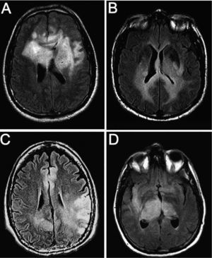 Resonancia magnética con secuencias FLAIR de 4 pacientes diagnosticados de gliomatosis cerebral. Destaca una hiperintensidad difusa y bilateral de predominio hemisférico y diencefálico.