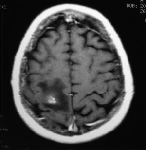 Resonancia magnética cerebral, secuencia T1: imagen parietal derecha compatible con metástasis.