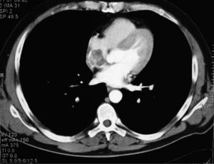 Tomografía computarizada torácica: imagen nodular en la aurícula derecha.