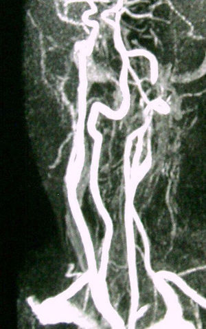 Angiografía por resonancia magnética de troncos supraaórticos: muestra irregularidad y disminución de calibre en la porción posbulbar de la arteria carótida interna izquierda, indicativo de disección.