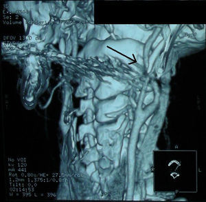 Angiografía por tomografía computarizada cervical: reconstrucción en 3D que muestra íntimo contacto entre apófisis estiloide y arteria carótida interna izquierda.