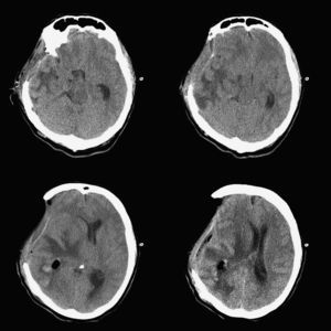 La tomografía computarizada muestra concavidad marcada del cerebro en el sitio de la craniectomía con desplazamiento de las estructuras de la línea media y pneumoencéfalo.