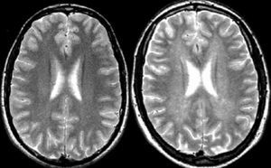 Resonancia magnética cerebral. Secuencias ponderadas en T2 obtenidas en el plano transversal en un sujeto sano (izquierda) y en un paciente con esclerosis múltiple (EM) (derecha). Obsérvese la discreta hiperseñal difusa que muestra la sustancia blanca hemisférica en el paciente con EM (dirty white matter).