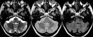 Resonancia magnética cerebral. Secuencias ponderadas en T2 (izquierda), densidad protónica (centro) y fast-FLAIR (derecha) en el plano transversal en un paciente con esclerosis múltiple clínicamente definida. Se observan múltiples y pequeñas lesiones desmielinizantes, muchas de ellas no visibles en la secuencia fast-FLAIR.
