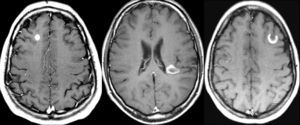 Resonancia magnética cerebral (secuencias ponderadas en T1 tras la administración de contraste) en 3 pacientes diferentes que muestran lesiones con actividad inflamatoria. Nótese los diferentes tipos de realce: nodular (izquierda), en anillo (centro) y en anillo incompleto (derecha). Este último patrón de realce es muy característico de las lesiones inflamatorio-desmielinizantes.