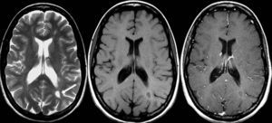 Resonancia magnética cerebral. Secuencias ponderadas en T2 (izquierda), T1 (centro) y T1 con contraste (derecha) en el plano transversal en un paciente con esclerosis múltiple secundariamente progresiva. Obsérvese la lesión desmielinizante subcortical posterior en el hemisferio cerebral izquierdo (flecha), la cual muestra un anillo hiperintenso en la secuencia T1 con contraste. Esta lesión no se realza con el contraste.