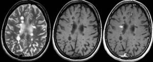 Resonancia magnética cerebral. Secuencias ponderadas en T2 (izquierda), T1 (centro) y T1 con contraste (derecha) en el plano transversal en un paciente con esclerosis múltiple secundariamente progresiva. Obsérvese como muchas de las lesiones visibles en las secuencias T2 son hipointensas en las secuencias T1, sin mostrar realce tras la administración de contraste (agujeros negros irreversibles).
