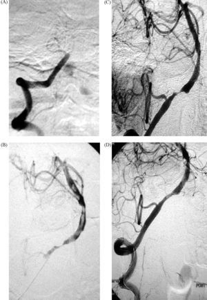 A: arteriografía digital selectiva de arteria vertebral (AV) derecha donde se aprecia oclusión completa de la arteria basilar (AB) en su segmento proximal. B: tras disrupción mecánica del trombo con el microcatéter y administración local de 5mg de t-PA, se consigue una recanalización parcial de la AB; se aprecian múltiples defectos de repleción compatibles con trombos. C: tras la administración de otros 5mg de t-PA se consigue la recanalización completa; se visualiza una estenosis crítica en la unión vertebrobasilar. D: imagen final tras angioplastia y colocación de stent intracraneal, donde se observa una estenosis residual.