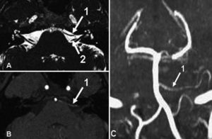 Paciente con espasmo hemifacial esencial izquierdo: contacto neurovascular entre la arteria cerebelosa anteroinferior (1) y la porción cisternal distal del nervio facial (2) del lado izquierdo. A: secuencia CISS. B: secuencia angiográfica TOF. C: reconstrucción coronal MIP del sistema vertebrobasilar.