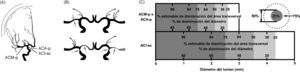 Representación del método para graduar el vasospasmo en la arteriografía del sistema carotídeo. A: esquema de la ubicación de las principales ramas de la carótida interna en una vista anteroposterior. ACA-p: segmento proximal de la arteria cerebral anterior; ACI-sp: segmento supraclinoideo de la arteria carótida interna; ACM-p: segmento proximal de la arteria cerebral media. B: diferentes grados de vasospasmo. C: método práctico para estimar el porcentaje de estenosis acorde al diámetro del lumen arterial. Una reducción del 50% del diámetro se estima que equivale al 75% de disminución del área transversal. Porcentaje de estenosis=[1−((D estenosis 1×D estenosis 2)/(D normal 1×D normal 2))]×100. Donde D estenosis 1 y D estenosis 2 = diámetros del segmento estenótico en dos planos, y D normal 1 y D normal 2 = diámetros de la arteria normal en dos planos. En la práctica se requiere de la magnificación de las imágenes para delinear claramente los bordes de las arterias y apreciar diferencias de 0,1mm.