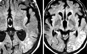 Resonancia magnética craneal: secuencia FLAIR en la que se aprecia hiperintensidad en la región parietooccipital izquierda. En la imagen de la izquierda, se aprecia realce de la lesión tras contraste.