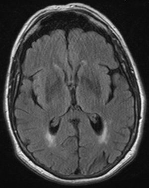 Resonancia magnética craneal potenciada en T1 en la que se observa una significativa atrofia cortical en ambos lóbulos frontales. Por el contrario, la corteza cerebral en los lóbulos temporales es normal.