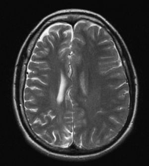 Resonancia magnética cerebral, plano axial, en secuencia T2: se evidencia una atrofia general de todo el hemisferio cerebral derecho con dilatación del ventrículo homolateral en ausencia de lesiones vasculares.