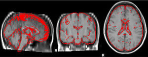 Herramienta FAST utilizada para segmentar la imagen obtenida por BET (brain extraction tool) en sustancia gris neocortical, sustancia blanca y líquido cefalorraquídeo.