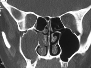 Tomografía computarizada de senos paranasales: lesión ocupante de espacio en los senos frontal y maxilar y las celdillas etmoidales.