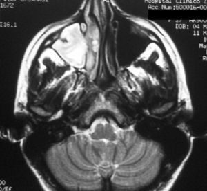 Resonancia magnética cerebral, secuencias ponderadas en T2: lesión ocupante de espacio en senos derechos compatible con rinosinusopatía.