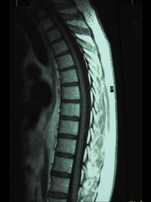 Resonancia magnética de columna dorso lumbar, corte sagital en secuencia T2, con pequeña protusión discal D7-D8.
