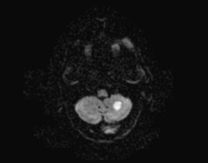 Imagen de resonancia magnética en secuencia de difusión que muestra hiperseñal en el hemisferio cerebeloso izquierdo compatible con isquemia aguda.