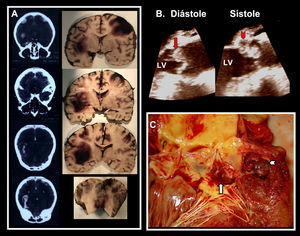 A: Tomografía computarizada y cortes necrópsicos encefálicos mostrando múltiples áreas hemorrágicas (supra e infratentoriales). B: Gran vegetación en la sigmoidea aórtica coronaria izquierda (flecha), complicada con absceso perivalvular (punta de flecha) y perforación valvular. Ecocardiograma transesofágico: imagen longitudinal de la raíz aórtica a nivel del plano valvular, que muestra la verruga aórtica protuyendo en el tracto de salida del ventrículo izquierdo en diástole. C: Imagen necrópsica: apertura longitudinal de la raíz aórtica a nivel del plano valvular mostrando esos mismos hallazgos.