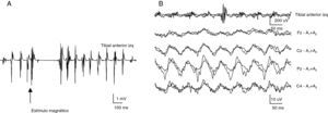 A: Modulación del temblor ortostático con la estimulación magnética transcraneal sobre el córtex motor. Registro sobre músculo tibial anterior. B: Back-averaging que muestra actividad oscilatoria sincronizada con el temblor de la pierna. Cz, Fz, Pz y C4: localización de los electrodos de registro según la colocación de sistema internacional 10/20. Referencia A1+A2: orejas ligadas.