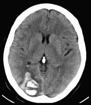 TC cerebral en la que se aprecia un hematoma occipital derecho en evolución.
