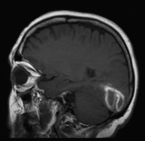 RM cerebral secuencia T1 en la que se observa una lesión hiperintensa ubicada a nivel occipital derecho, presentando un diámetro máximo medido de 42mm y muy discreto edema perilesional, compatible con hemorragia parenquimatosa.