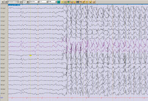 EEG (registro monopolar): descargas de punta-onda a 3Hz generalizadas.