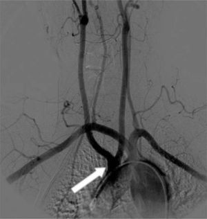 Arteriografía de troncos supraaórticos. Flecha en blanco muestra tronco común de origen de ambas arterias carótidas comunes.