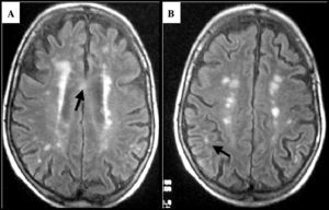 Estudio de RM craneal (secuencia FLAIR) del paciente de mayor edad de la serie (76 años): se observan múltiples áreas de hiperseñales en sustancia blanca, muchas de ellas de situación periventricular y con eje mayor perpendicular a los ventrículos laterales; las flechas señalan otras lesiones en cuerpo calloso (A) y yuxtacorticales (B).